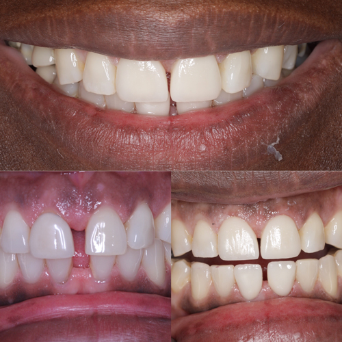 Porcelain-Veneers-Cosmetic-Dentistry-Dr-Pretam-Gharat-London-1