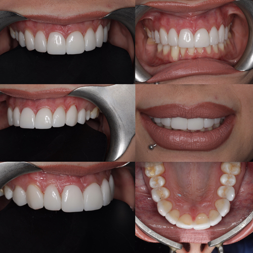 Porcelain-Veneers-Smile-Design-Dr-Pretam-Gharat-London-2