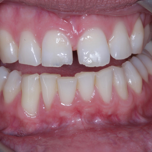 Porcelain-Veneers-Smile-Design-Dr-Pretam-Gharat-London-3